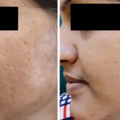 This patient struggled with deep boxcar and rolling acne scars. The after photo shows a dramatic improvement in skin smoothness and texture following a series of CO2 laser sessions, helping to restore their confidence.