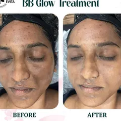 See the immediate transformation with our BB Glow treatment. This client wanted to address uneven skin tone and blemishes. The 'after' photo shows how the semi-permanent serum provides light coverage, reduces redness, and creates a flawless, dewy finish.