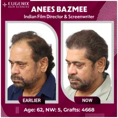 A complete view of Director Anees Bazmee's transformation from all angles, showing the density and natural hairline we created.