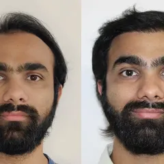 This is a perfect example of a complete transformation. We addressed both the receding hairline and the thinning on top. By carefully designing the hairline and ensuring high-density packing, the final result is seamless and looks like he never lost any hair at all.