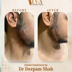 Treating keloids on the face and neck requires a delicate, precise approach. This patient had a prominent keloid along his jawline. We used a combination therapy to carefully flatten and soften the scar tissue over a few sessions, significantly improving its appearance and texture.