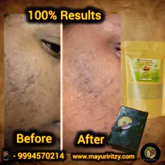 This before and after image shows the powerful effect of my Acne & Pores kit. You can see a significant reduction in acne and a clearer complexion. My face pack and soap work together to tackle breakouts and give you 100% results.