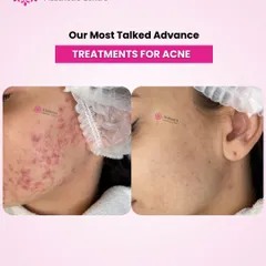 This before-and-after of acne treatment shows a dramatic reduction in inflammation and breakouts. My approach is to create a personalized plan that not only clears current acne but also prevents future flare-ups.
