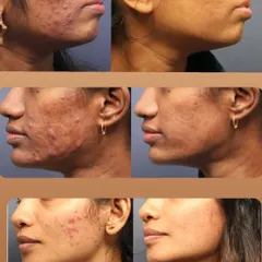 A Life-Changing Acne Transformation. This before-and-after gallery shows the journey from severe, painful acne to clear, healthy skin. My approach combines medical diagnosis with a personalized treatment plan to not only clear active breakouts but also improve skin texture and confidence.