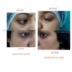 Two successful examples of non-surgical under-eye correction using dermal fillers. Both before-and-after sets show a visible improvement in hollowness and dark circles, leading to a brighter and less tired look.