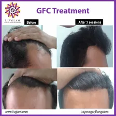 This client's hairline was restored after just three sessions of our non-surgical GFC treatment. Notice the significant increase in hair density and the natural-looking frontal coverage.