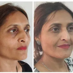 A closer look at the results of our Organic Lift treatment. This transformation was achieved using a gel made from the client's own blood to naturally restore volume and smooth the skin around the eyes.