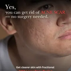 This image highlights our non-surgical approach to treating acne scars. With fractional CO2 laser resurfacing, we can effectively target and reduce the appearance of pitted scars without the need for surgery.