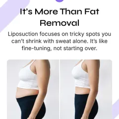 Liposuction is a fine tuning tool. It is most effective for targeting specific areas of fat that do not respond to traditional weight loss methods, allowing me to sculpt and enhance your natural body shape.