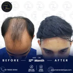 A top-down view showing the incredible density achieved 12 months after a BIO FUE hair transplant. We successfully covered the balding area for a complete look.