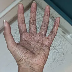 To provide a different perspective, here are 100 strands of shed hair spread across my hand. Understanding this baseline can help reduce anxiety about normal shedding and signal when to seek professional help.