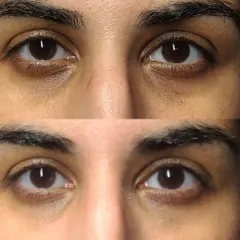 A clear example of how my under-eye treatment works in just one session. This before-and-after shows a significant reduction in dark circles and hollows, making the eyes look instantly brighter and more rested.