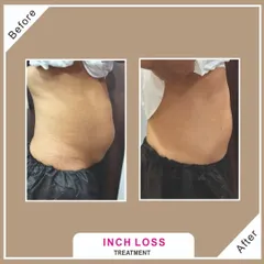 A visible reduction in inches and improved skin texture on the abdomen. Our inch loss programs combine multiple technologies to effectively target fat and tighten skin in the same treatment plan.