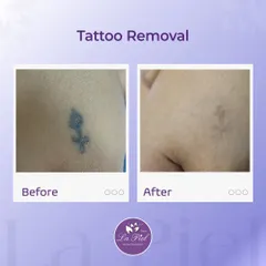 This before-and-after demonstrates the effectiveness of our advanced laser tattoo removal process. The treatment works by breaking down the ink particles over a series of sessions, allowing the body to clear them and gradually fade the tattoo, leaving the skin looking clearer.
