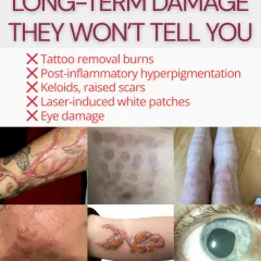 This collage illustrates the long-term damage from improper laser treatments, including burns, keloid scars, and even eye damage. We use this to educate patients on the importance of choosing a qualified dermatologist for any laser procedure.