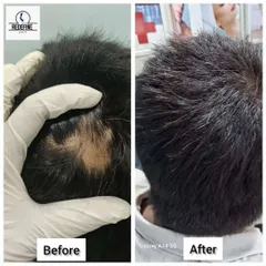 Another clear example of our success in treating alopecia areata. The bald patch is completely filled in with new hair after undergoing our personalized treatment protocol.