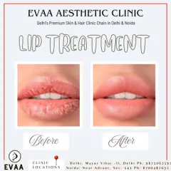 This before and after comparison showcases the effectiveness of our lip treatment for chapped and dehydrated lips. The result is visibly smoother, hydrated, and healthier-looking lips.