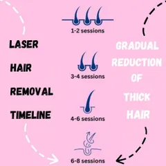 Laser hair reduction is a journey, not a one-time fix. This timeline shows you what to expect, from the gradual reduction of thick hair in the first few sessions to achieving up to 80% permanent reduction after a full course of 6 to 8 sessions.