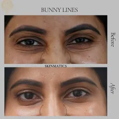 Bunny lines are the small wrinkles that appear on the side of the nose when you smile or scrunch your face. Here, you can see how a few precise Botox injections effectively smoothed these lines for a softer look.