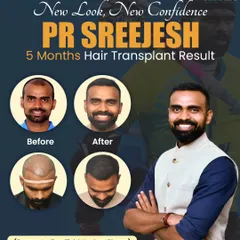 I had the honor of helping PR Sreejesh, the legendary Indian hockey player, restore his hair. This before-and-after collage shows his significant progress just 5 months into the journey, demonstrating how effective a well-planned transplant can be.