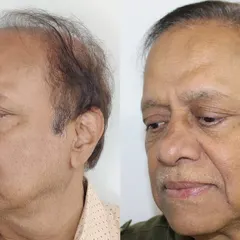 This angle shows the natural-looking density and the soft hairline we created, which is crucial for a patient with this level of initial hair loss.