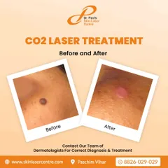 This is another example of a CO2 laser treatment for mole removal. The 'after' photo shows the area immediately post procedure, which then heals to reveal clear skin.