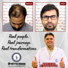 This patient with Grade 5 baldness is a testament to what is possible. After implanting 5200 grafts, we achieved this complete transformation in 12 months, restoring his confidence along with his hair.