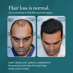 This before and after comparison shows how we help clients feel like themselves again. Our DHI procedure effectively restores lost hair, creating a fuller, natural look that rebuilds confidence.