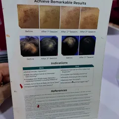 This is another view of the documented results from Exosome treatments. The progression photos clearly show the gradual improvement in both skin hyperpigmentation and hair thinning after just a few sessions, highlighting the therapy's dual-action benefits.