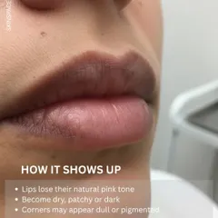 Here's how lip pigmentation typically shows up. The lips lose their natural pink tone, become dry and patchy, and the corners may appear dull or dark.