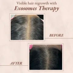 This is a clear example of visible hair regrowth achieved with our non-surgical Exosomes Therapy. The after photo shows significantly improved hair density and scalp coverage, demonstrating how the treatment works from within to rejuvenate hair follicles.