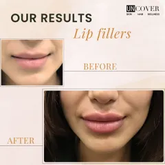This is a great example of our approach to lip fillers. We focus on enhancing the natural shape and restoring volume for a soft, beautifully balanced result that complements your features.