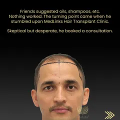 Tika Ram came to us skeptical but desperate after friends' suggestions for oils and shampoos failed. This image shows the beginning of his journey, where we designed a personalized hairline to restore his natural look.