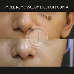 This before and after image shows a mole removal procedure using Radio Frequency Ablation. This technique allows for the precise and safe removal of benign moles with minimal scarring, providing a clean aesthetic result.