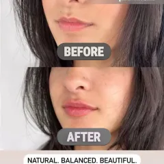 A clear demonstration of a natural lip filler enhancement. The 'after' image shows beautifully balanced, hydrated, and defined lips that complement the client's facial features without looking overdone.