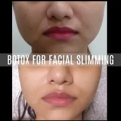 A strong, square jawline can sometimes create a sense of heaviness in the lower face. Using Botox in the masseter muscle is a non-surgical technique I use to soften the jawline, creating a slimmer, more balanced facial profile.