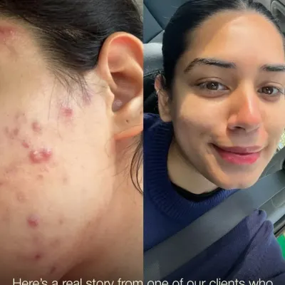 A real patient's before-and-after transformation. This demonstrates the power of a medically guided acne treatment plan tailored to the individual's specific needs, leading to significant improvement in skin clarity and texture.