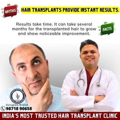 **Myth:** Hair transplants provide instant results. **Fact:** This is a long-term solution. It takes several months for the new hair to grow and for you to see the noticeable, final improvement. Patience is key.