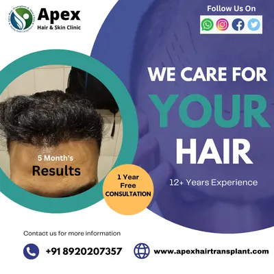 See the kind of results you can expect just five months after your procedure. We offer a free one-year consultation to monitor your progress and ensure you are completely satisfied with your hair restoration journey.