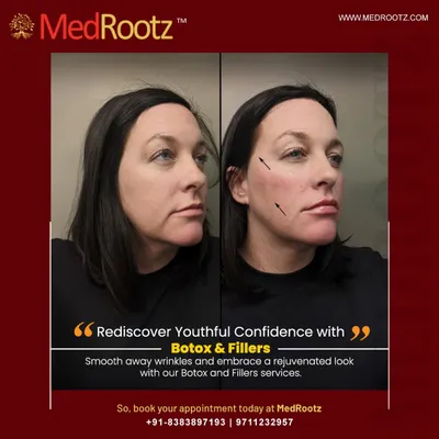 This before and after image demonstrates the subtle yet effective results of Botox and fillers. My focus is on smoothing wrinkles and rejuvenating the face in a way that looks entirely natural and enhances your own features.