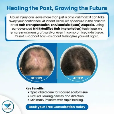 We specialize in complex cases, including hair transplantation on scar tissue (Cicatricial Alopecia). This before-and-after result shows how our advanced MHI technique can successfully restore hair even on skin compromised by a burn injury.
