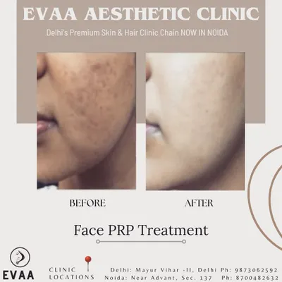 A striking before-and-after of a Face PRP Treatment, demonstrating significant improvement in skin texture and reduction of pigmentation and acne scars.