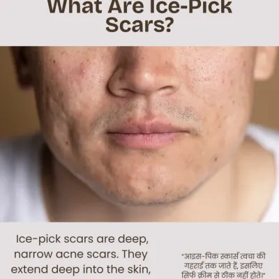 Let's start with the basics. Ice-pick scars are deep, narrow acne scars that extend far into the skin's dermal layer. This depth is why they are so difficult to treat with topical creams alone and require professional intervention.