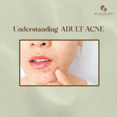 Understanding the underlying cause of adult acne is the first step toward effective management. This condition is often multifactorial, involving hormonal fluctuations, stress, and other triggers that require a targeted dermatological plan.