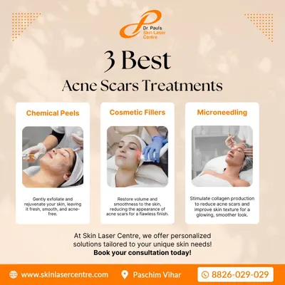 This graphic outlines my core treatment strategies for acne scars. I use chemical peels for exfoliation, cosmetic fillers to lift depressed scars, and microneedling to stimulate your skin's natural healing and collagen production for long-term improvement.