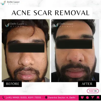 This before-and-after demonstrates the results of my customized acne scar removal plan. By combining different laser modalities, I can address various scar types on the face for a smoother, more uniform skin surface.
