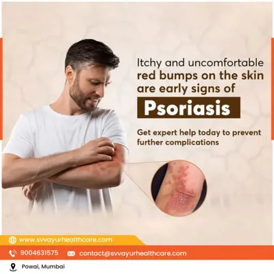 Psoriasis manifests as itchy, red, and scaly patches on the skin. My treatment plan for psoriasis involves internal detoxification, herbal medications, and lifestyle guidance to manage the condition effectively and reduce the frequency of flare-ups.
