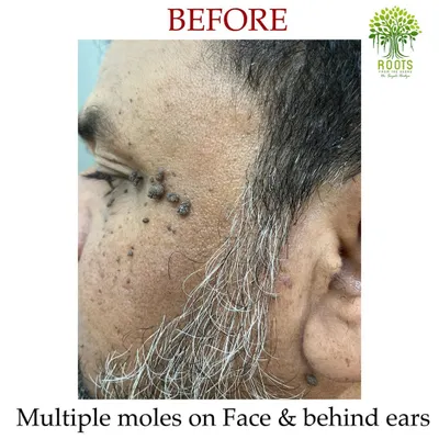 This "before" image shows a client with multiple moles on his face and behind his ears prior to starting Agnikarma therapy.