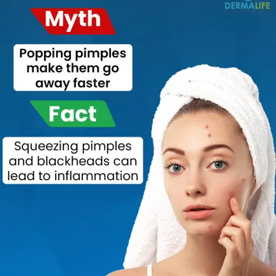 It is a fact that squeezing pimples and blackheads can lead to inflammation and scarring. This graphic helps bust a common myth. The best approach is always a gentle skincare routine and professional help when needed.