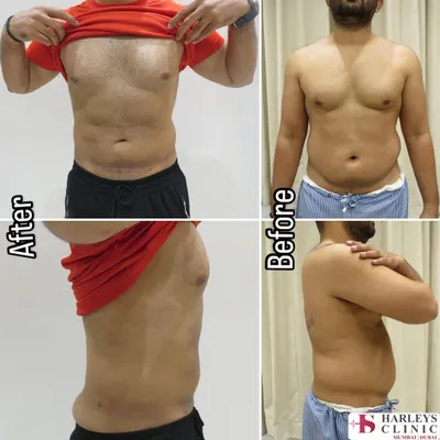 This before and after image demonstrates the transformative power of liposuction on the male torso. The procedure effectively removed stubborn fat from the abdomen and flanks, sculpting a more defined and athletic contour. This result is permanent, provided a stable weight is maintained.